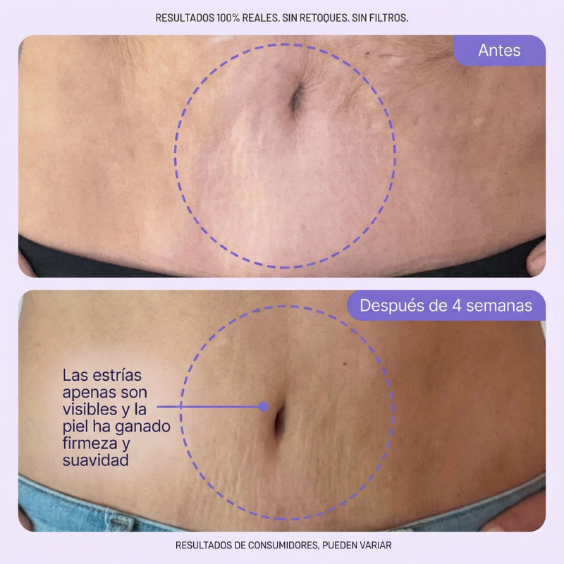TryAuré™ Crema Reafirmante Antiestrías