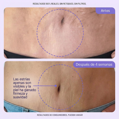 TryAuré™ Crema Reafirmante Antiestrías