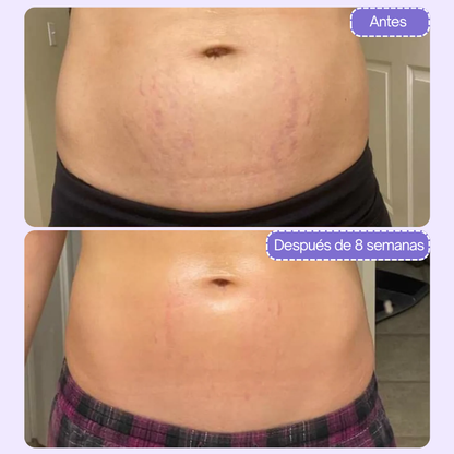 TryAuré™ Crema Reafirmante Antiestrías